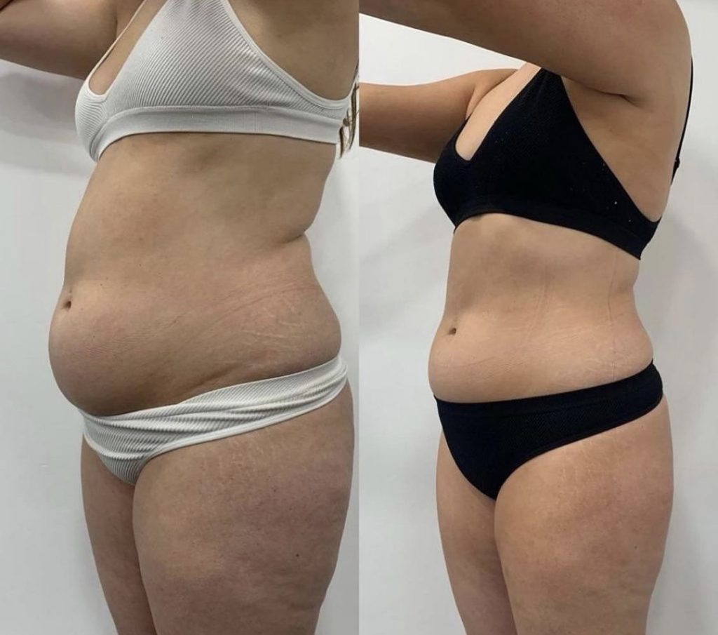 Before and after Emerald Laser contouring of the waist