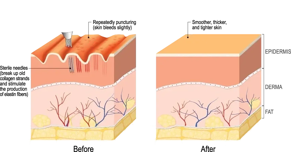 Skin cross section before and after Radiance RF, showing epidermis, derma, and fat