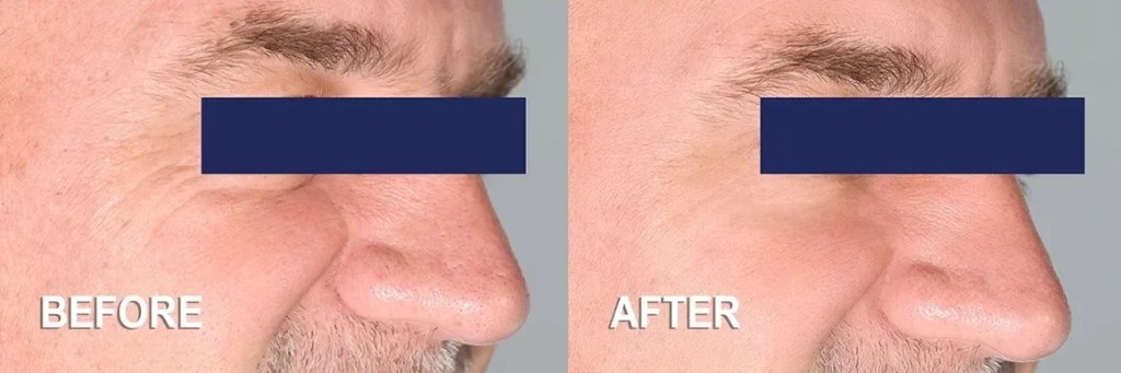 Before and after Radiance RF microneedling around the eye